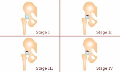 Stages of AVN of hip